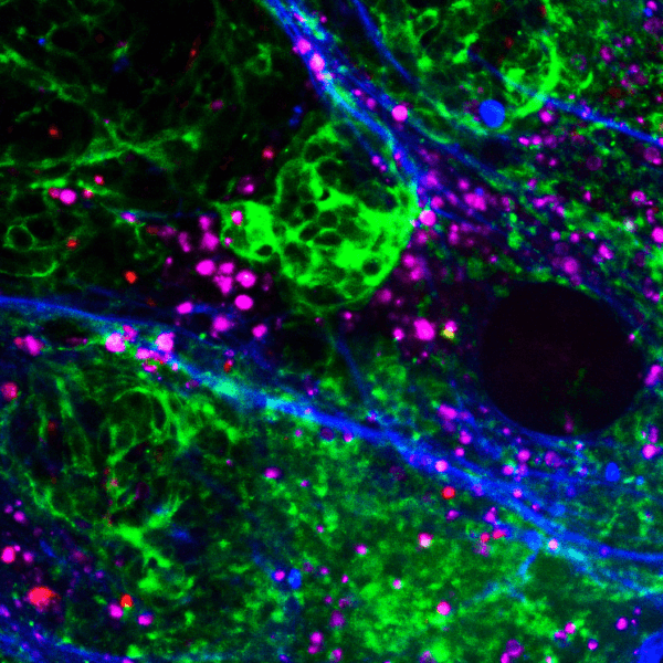 The Eye of the Tumour- Fran Balkwill