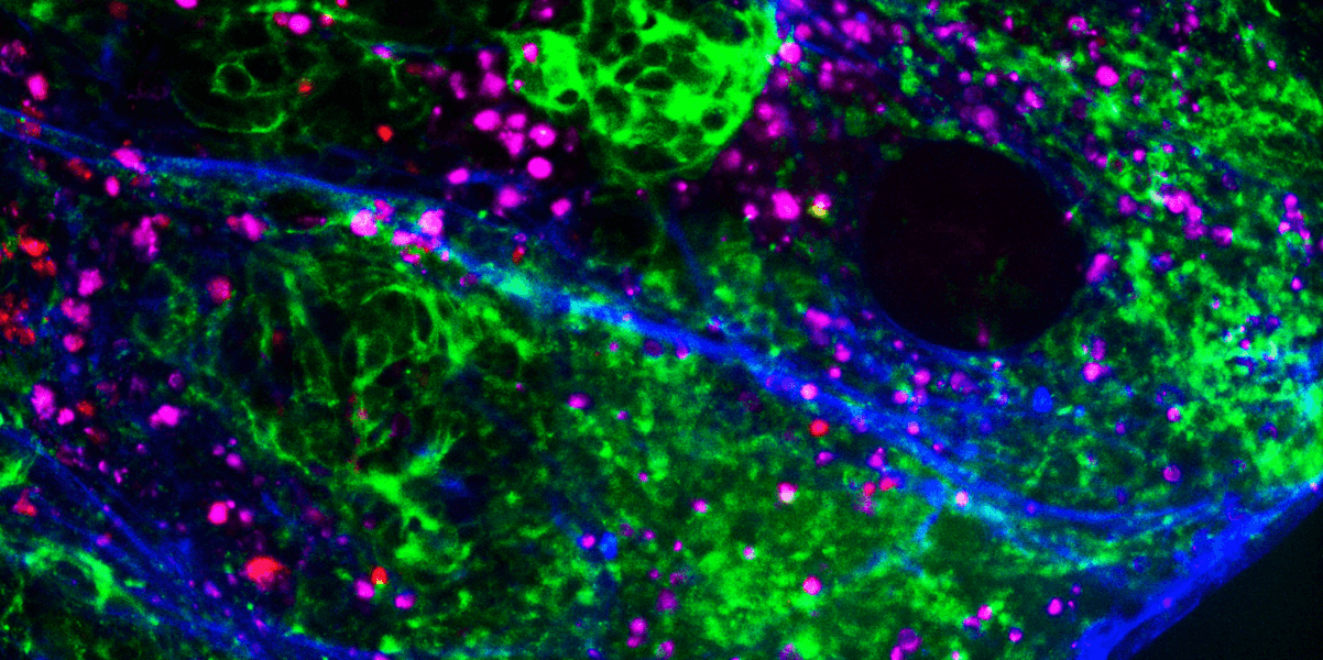 The Eye of the Tumour cropped