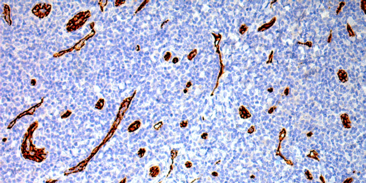 Vessels (CD31) CLL/SLL