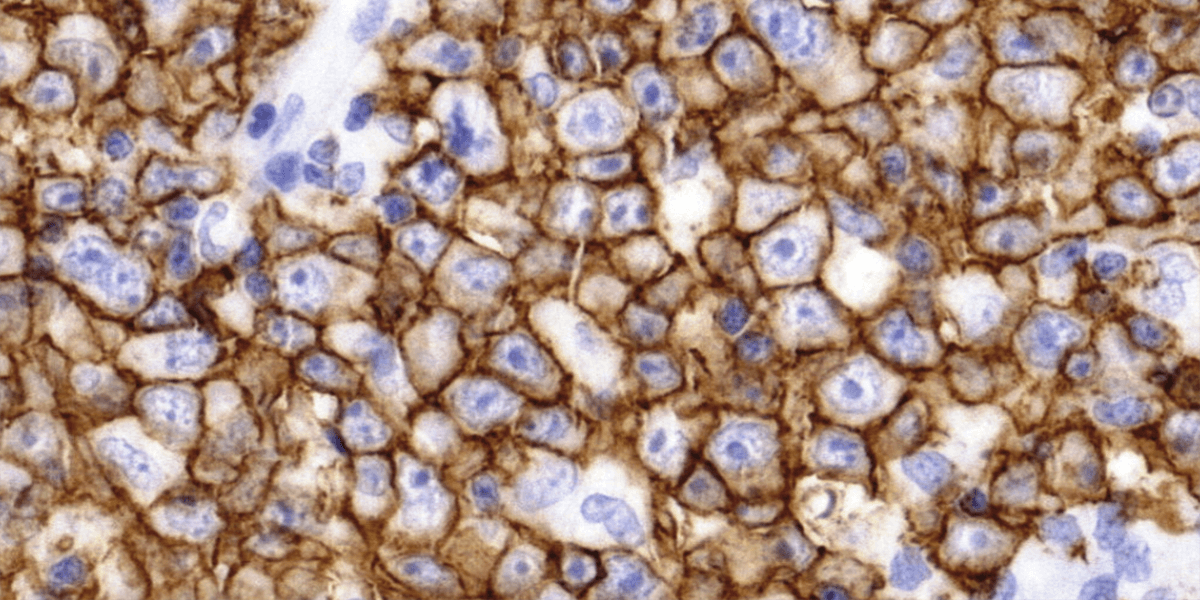 DLBCL - CD20 IHC