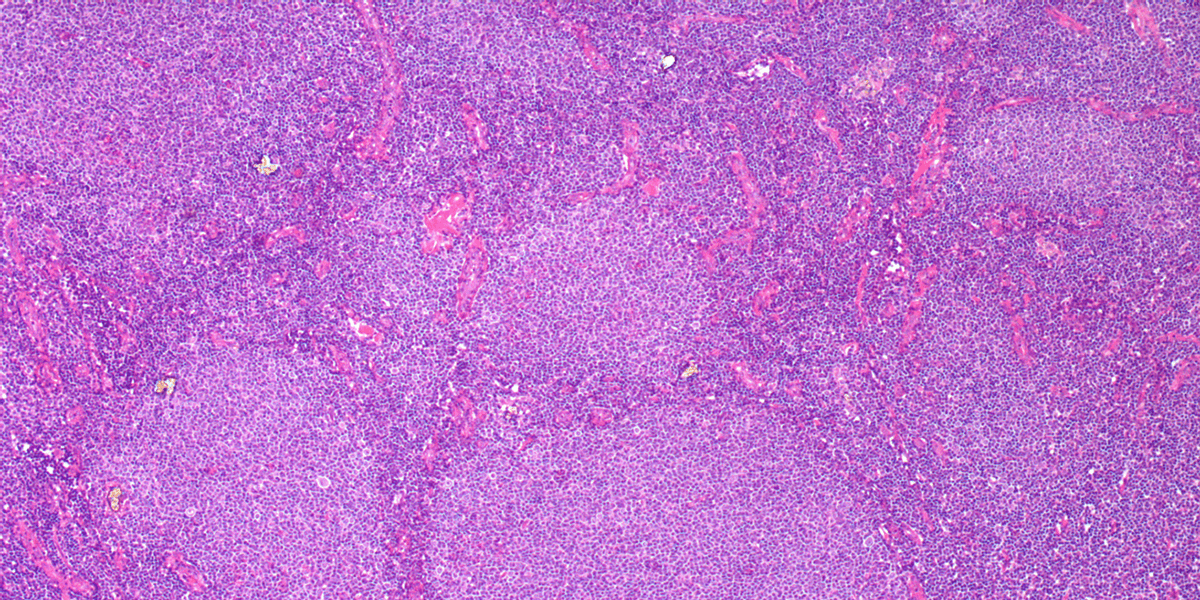 Follicular lymphoma - H&E