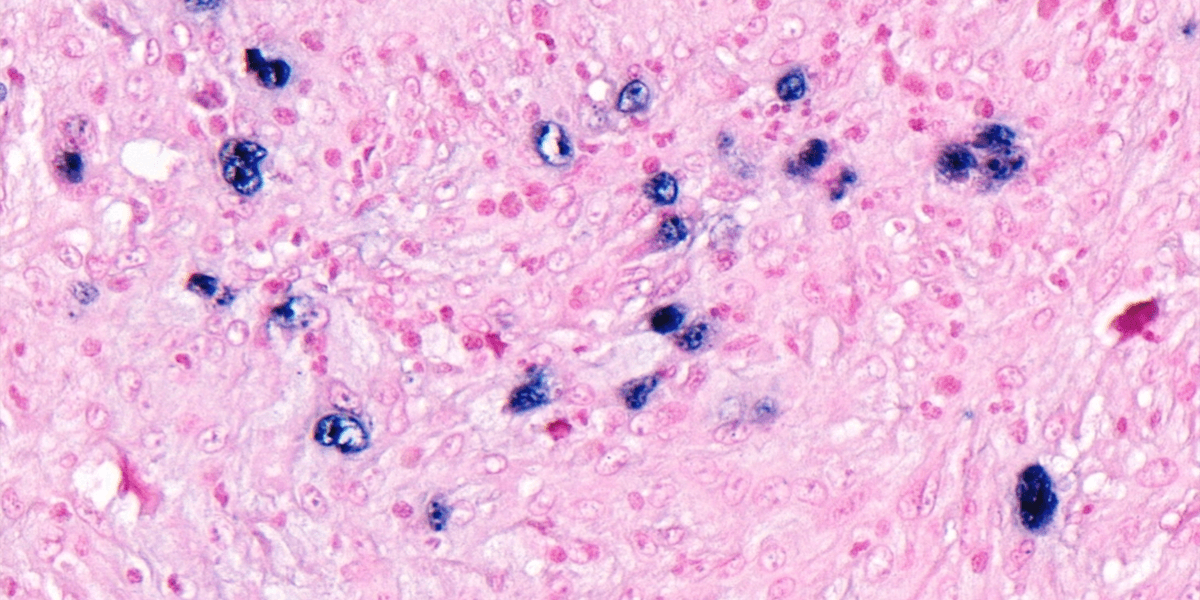 Hodgkins - EBV in situ hydribisation - blue