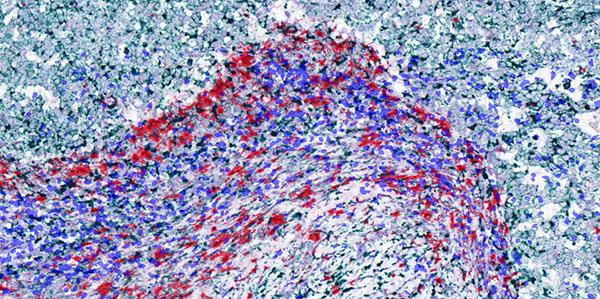 Localisation of versican (VCAN) mRNA (Red) around the tumour border leads to a limitation of CD8+ T cell (Blue) movement into the tumour island