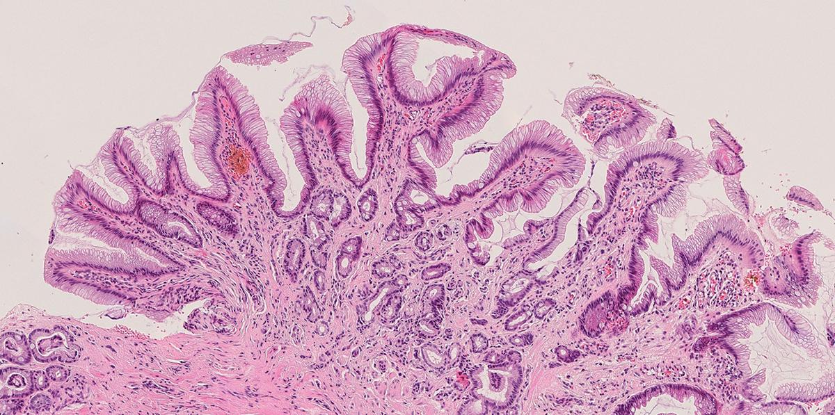 Microscopy image of Barrett’s oesophagus, showing its glandular structure.