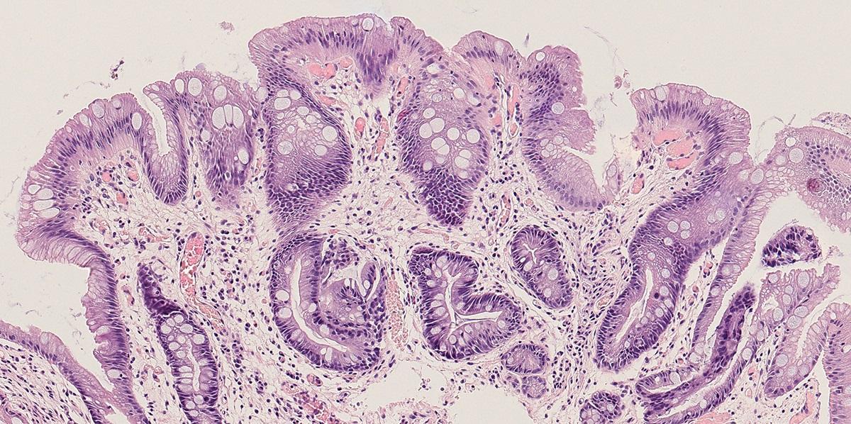 Barrett's oesophagus 2 - McDonald lab