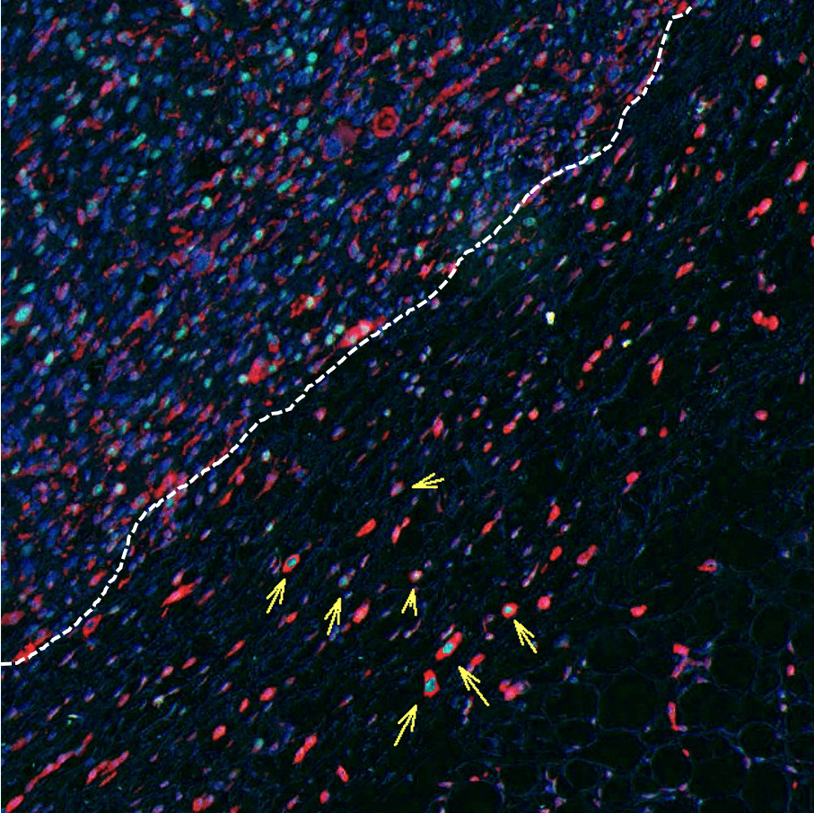 Aggressive melanoma cells at edge of tumours are key to cancer spread