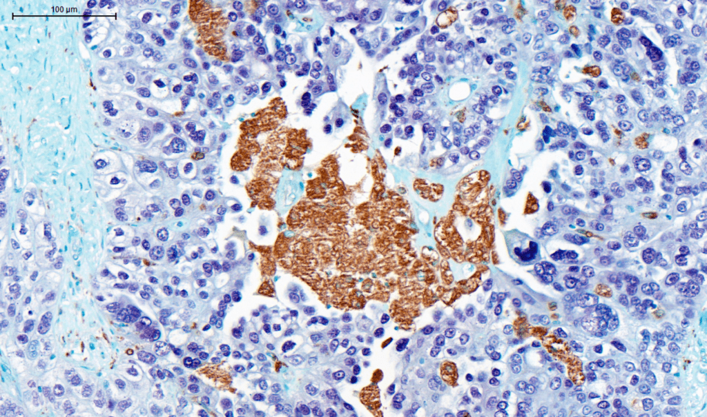 The impact of chemotherapy on immune cells in the tumour microenvironment.