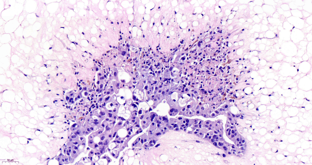 Microscopy image of one of the 3D multi-cellular models that will be used in the REMODEL project, made with cells obtained from cancer biopsies. Image shows cells that have been stained pink and purple using hematoxylin and eosin staining.