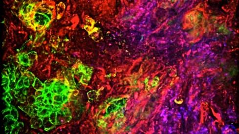 Ovarian tumour, showing cancer cells, immune cells and matrix