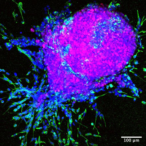 Spheroid model of breast cancer progression