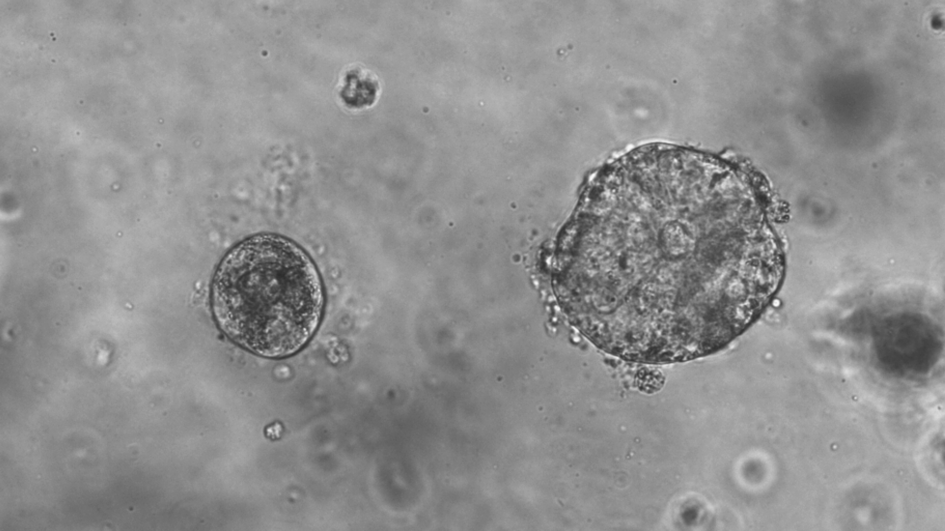 Cancer organoids established from liver metastasis.