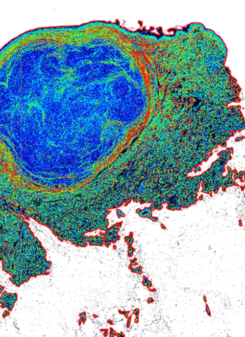 Heatmap of a human melanoma tumour showing the intensity of the extracellular matrix around the tumour.