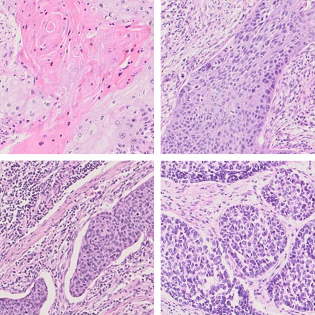 Histopathology images patient tissues representing the four subtypes: differentiated (top left), metabolic (top right), immunogeneic (bottom left), and stemness (bottom right).