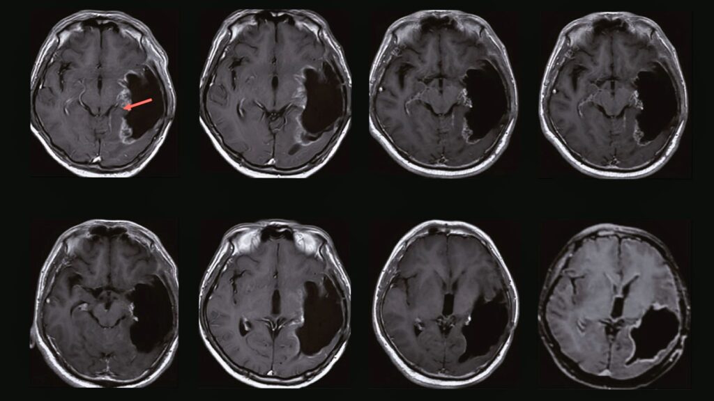 MRI brain scans of one of the trial participants who achieved a complete response. See original paper for more details. © Ning, W. et al. 2024 CC-BY 4.0