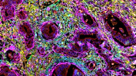 Immunofluorescence microscopy image of cells in pancreatic ductal adenocarcinoma.