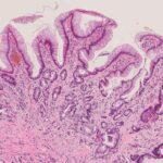 Barrett's oesophagus 1 - McDonald lab